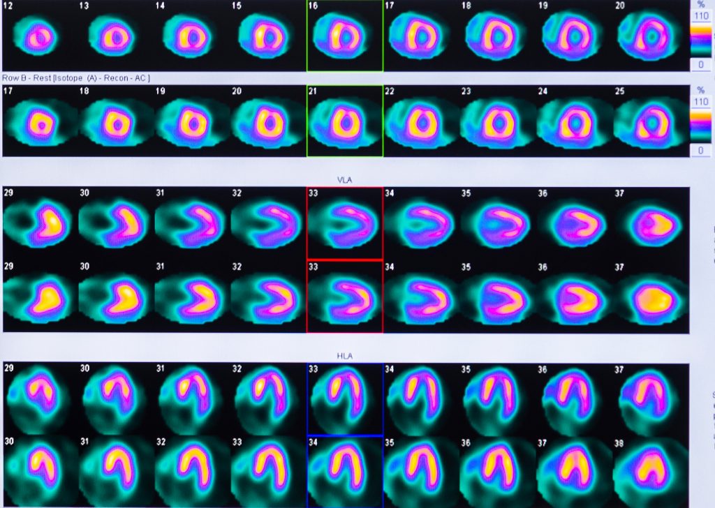 Nuclear Medicine Scan Heart