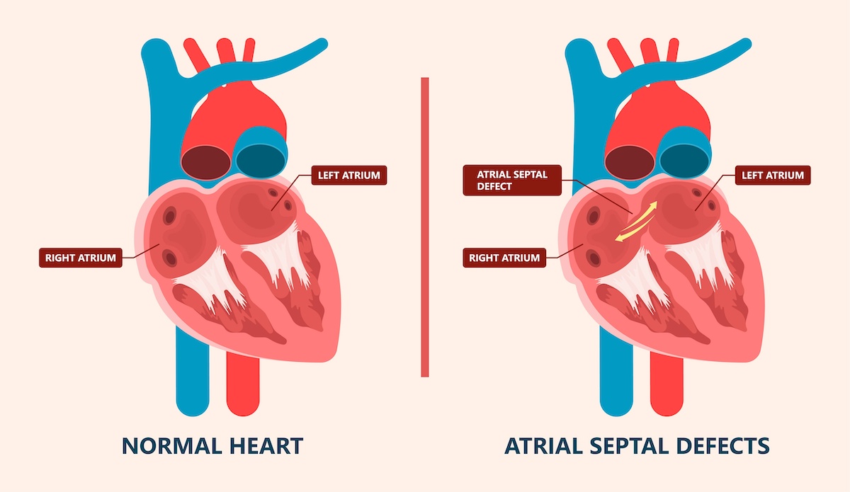 Atrial Septal Defect Patent Foramen Ovale Repair Clearwater